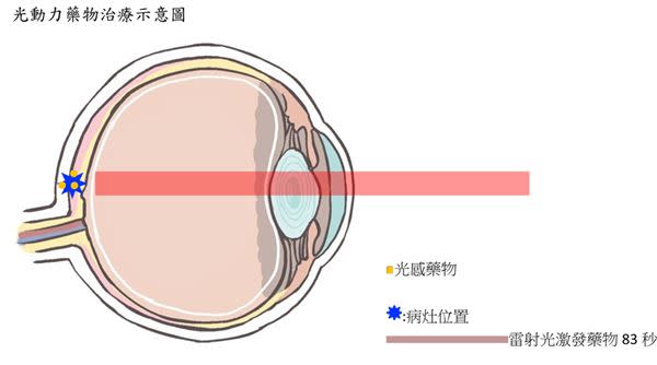 光動力藥物治療示意圖。（圖片提供／台中榮總）