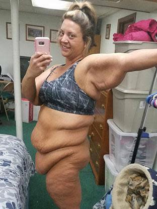 Woman raising 40k to remove 12kg skin