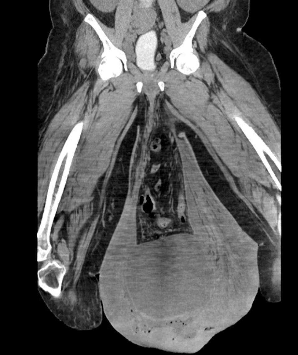 A CT scan of a man's abdomen shows large swollen testicles.