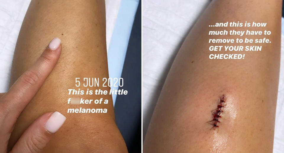 Picture of the tiny mole on Louise Hay's leg and a photo of the area when the mole was removed with stitches. 