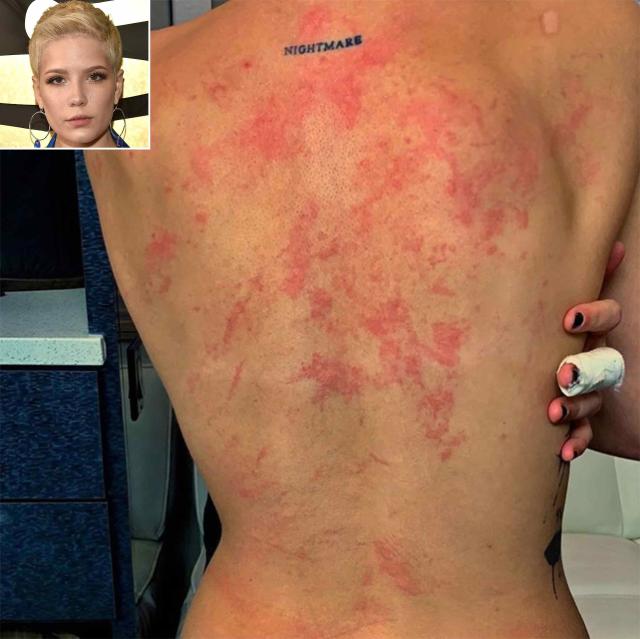 Halsey Shows Off Her Injured Back and Warns: 'Don't Go Rock