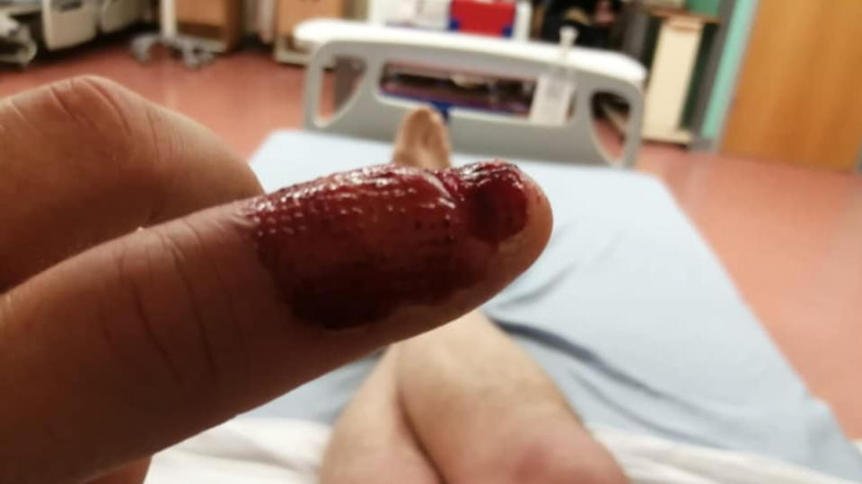 The infected finger after surgery.