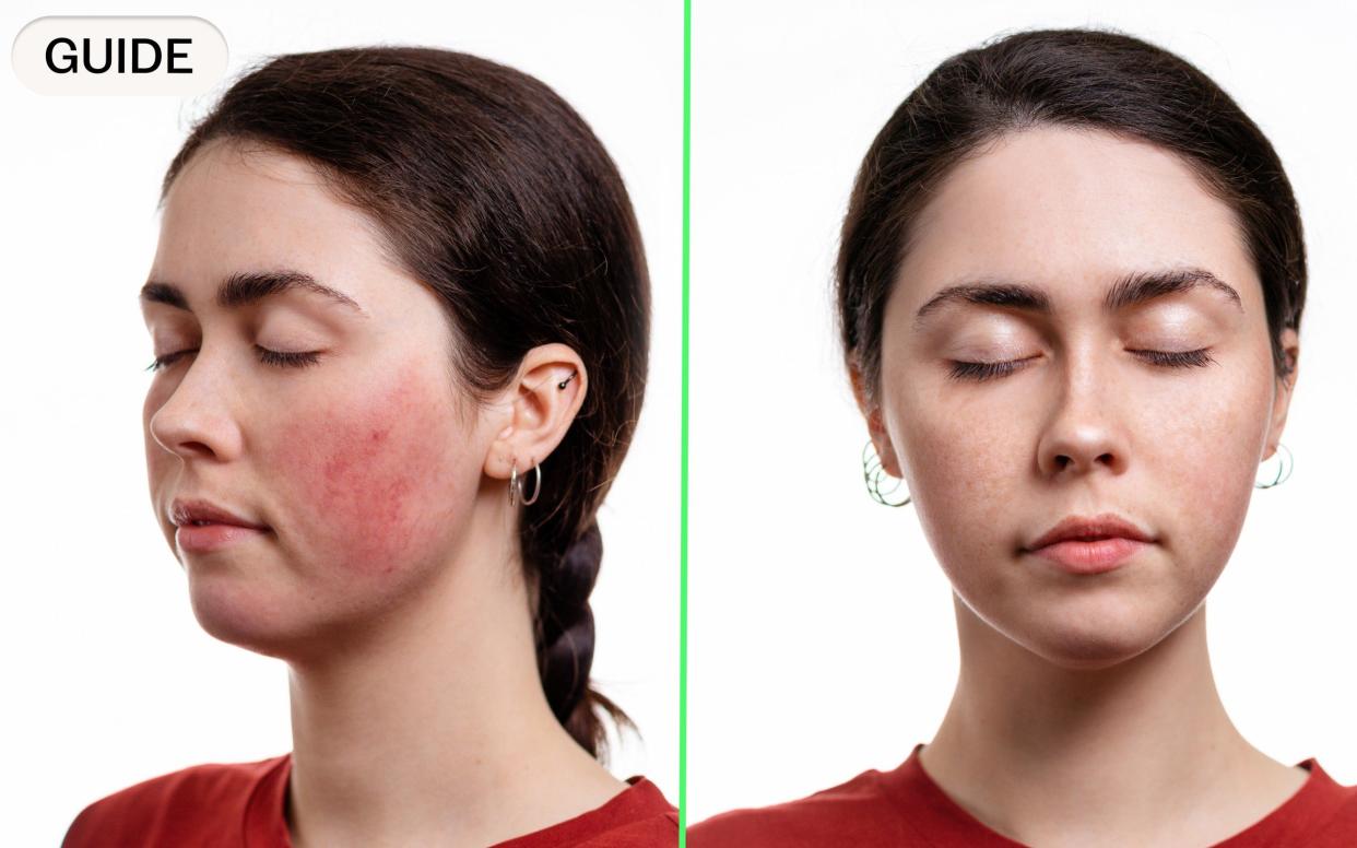 How rosacea can flare up