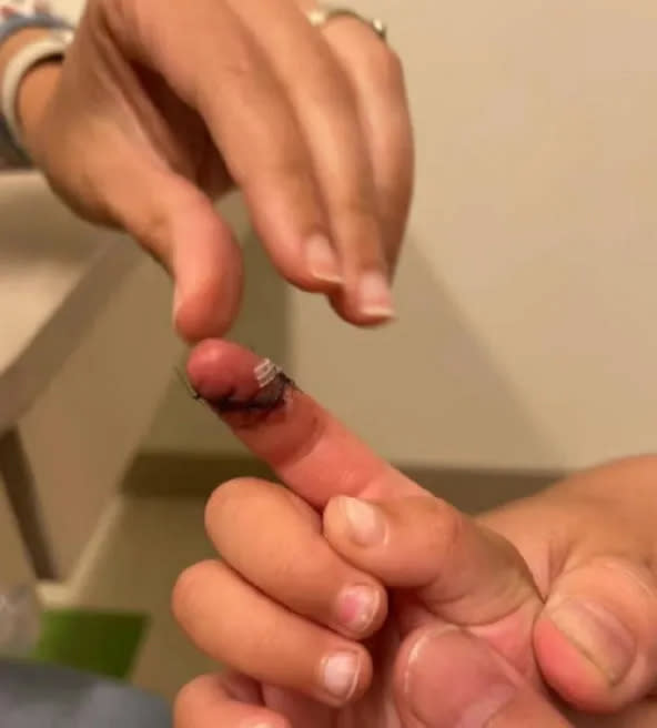 張恆指稱女兒手指有很長的傷口，是在鄭爽照顧期間受傷的。翻攝網易娛樂