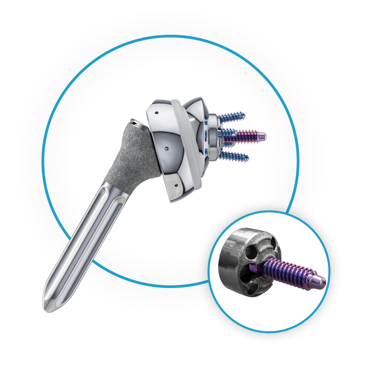 Anika Announces the Full Market Release of the RevoMotion™ Reverse Shoulder  Arthroplasty System during the 2023 Orthopaedic Summit: Evolving  Technologies (OSET) Annual Meeting