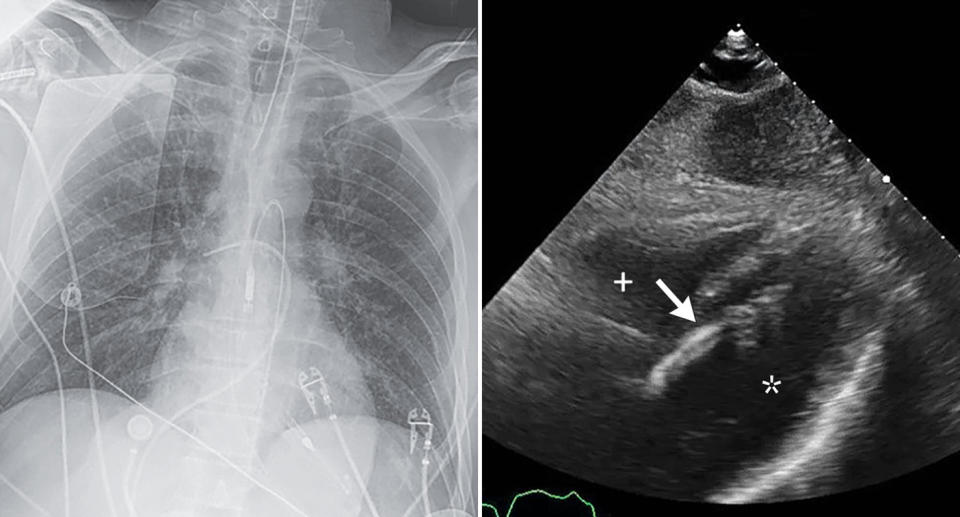 A chest radiograph is pictured next to a picture of a heart.