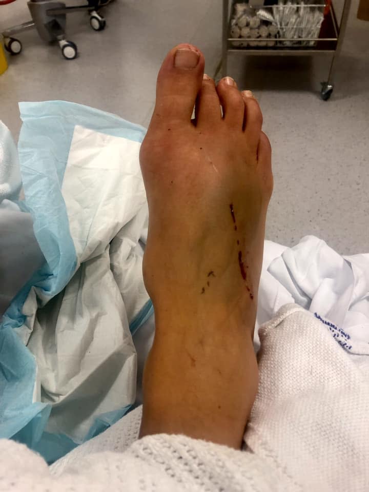 Her right foot was horribly disfigured in the accident. Source: Facebook