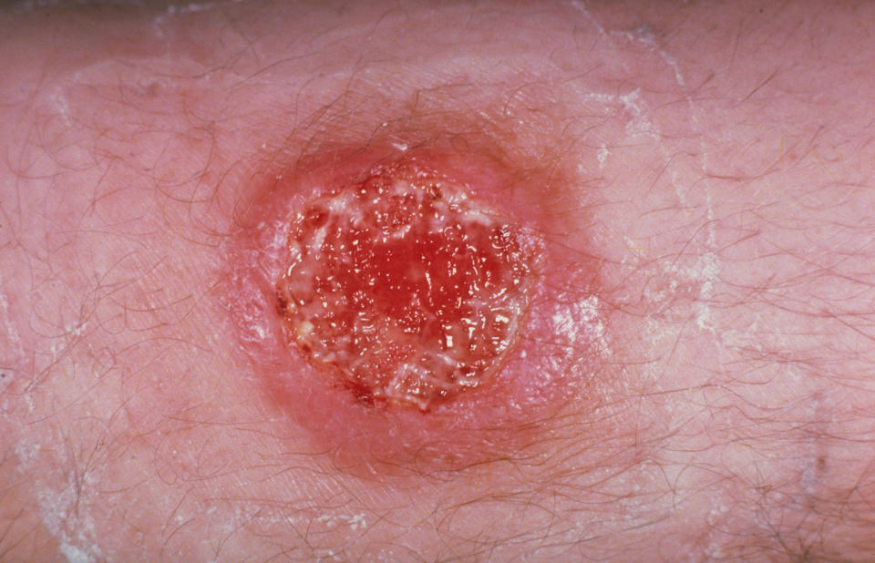 Leishmaniasis, caused by an intracellular protozoal parasite. The disease is transmitted by the bite of a sand fly. (Photo: Corbis Documentary/Getty Images)