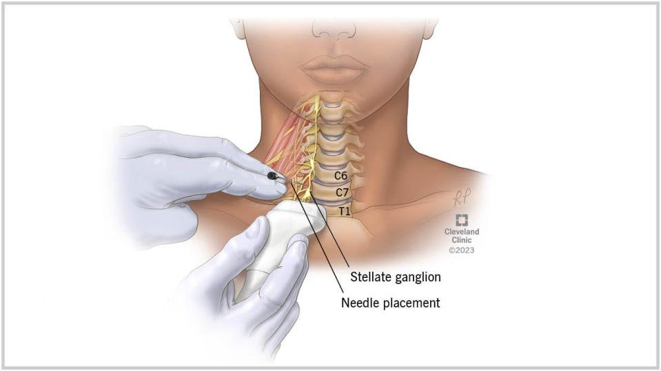 Doctors are beginning to use stellate ganglion injections to help people with lost/distorted taste and smell.