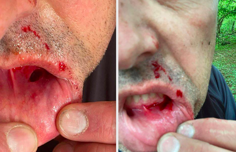 Neil Nunnerley needed three stitches after hitting the barrier on the bike trail. (Wales News)