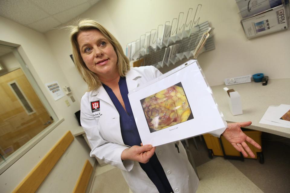 IU Health University Hospital gastroenterologist Dr. Monika Fischer shows a photo of a colon with severe C diff. Fischer does fecal transplants, transplanting healthy universal donor samples into ill patients suffering from such C. difficile, a common bacterial infection that has become resistant to antibiotics.