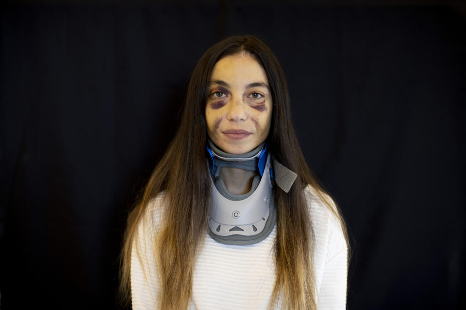 Clara Chammas, a psychologist and a health coach, who got injured at her apartment during the Aug. 4 explosion that killed more than 170 people, injured thousands and caused widespread destruction, poses for a photograph at her parents' house in Beirut, Lebanon, Friday, Aug. 14, 2020. (AP Photo/Hassan Ammar)