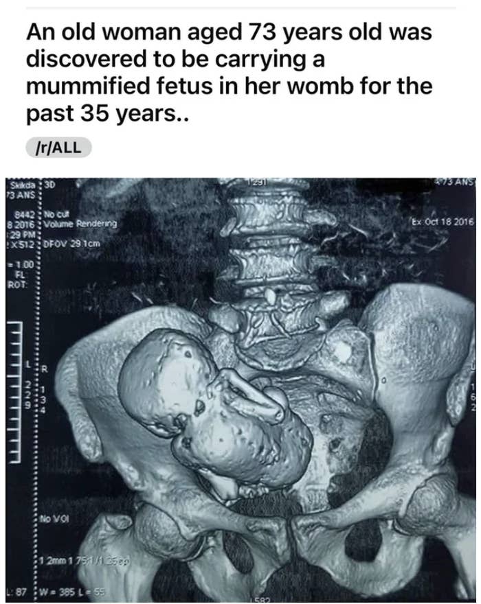 a fetus nestled in someone's pelvic area