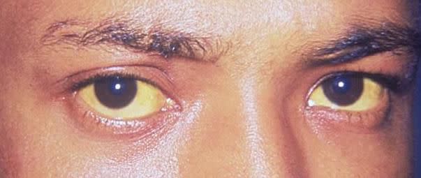 1) Your skin and eyes turn yellow.