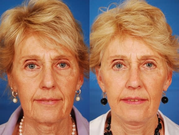 Here, a photo of participant Barbara Diehl before (left) and after (right) her lower eye and face lift. Post-surgery, Diehl showed a trend towards being perceived as more risk seeking, attractive and more sociable, though the trend was not stat