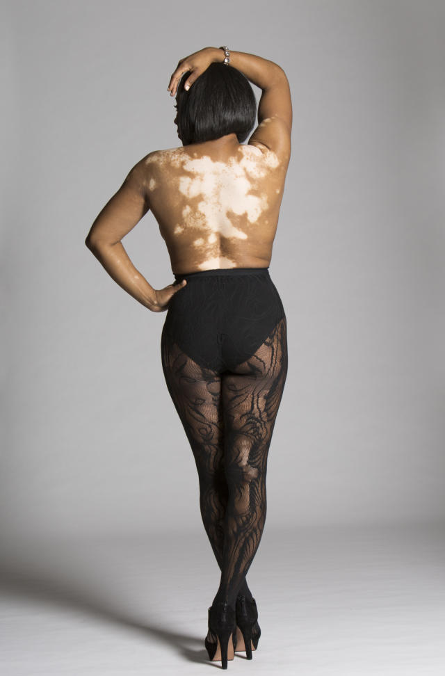 vitiligo models tumblr