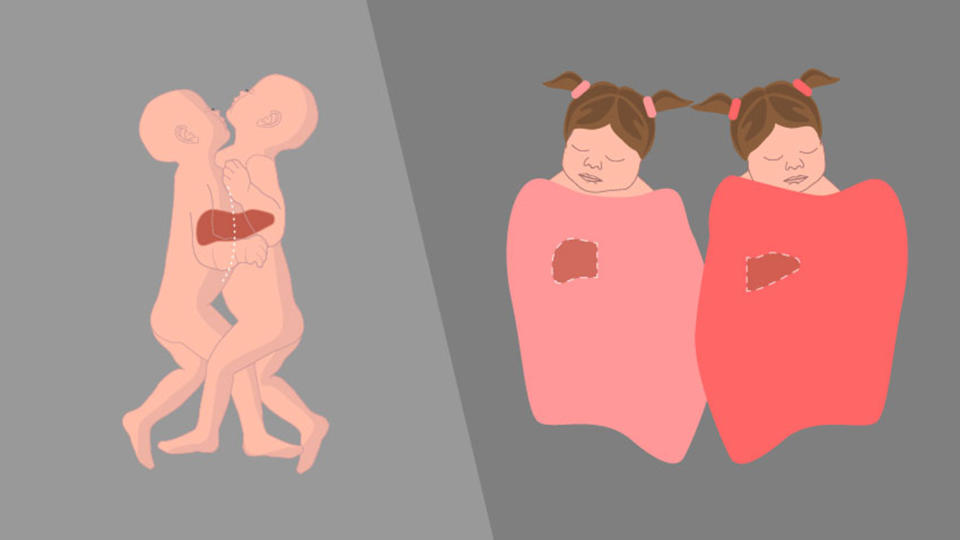 A diagram illustrates how Sarabeth and Amelia were conjoined and separated.  (Courtesy Michigan Medicine)