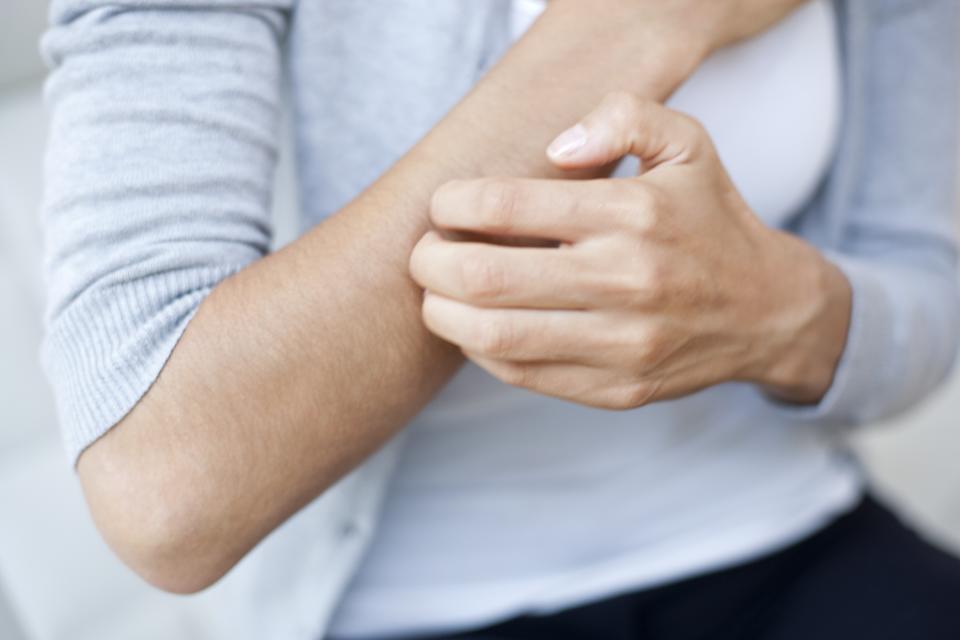 MODEL RELEASED. Woman scratching her arm, close up.