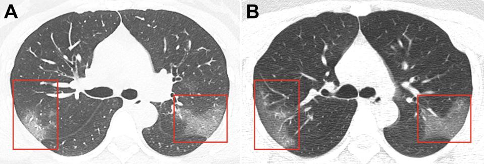 Coronavirus patient chest scan