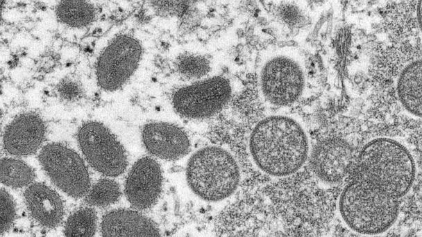 PHOTO: This 2003 electron microscope image made available by the Centers for Disease Control and Prevention shows mature, oval-shaped monkeypox virions, left, and spherical immature virions, right.  (CDC via AP, File)