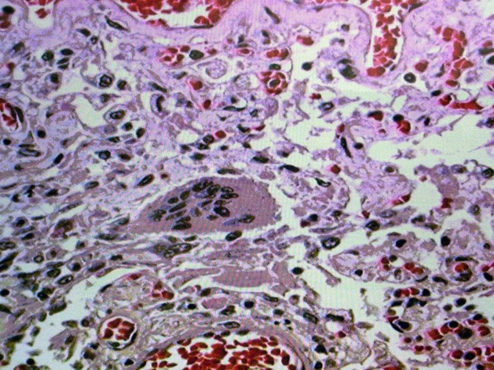 A slide of a SARS lung tissue sample is shown on Tuesday, April 1, 2003, on a HDTV at a Center for Disease Control in Atlanta.