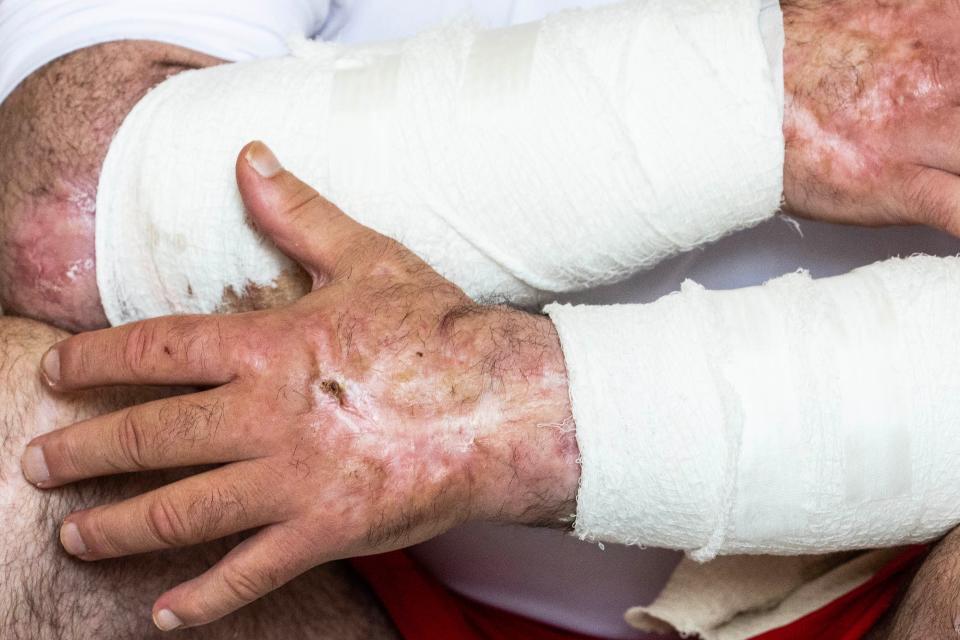 A man from Delaware shows his bandaged arms and scars on his hands from using xylazine.
