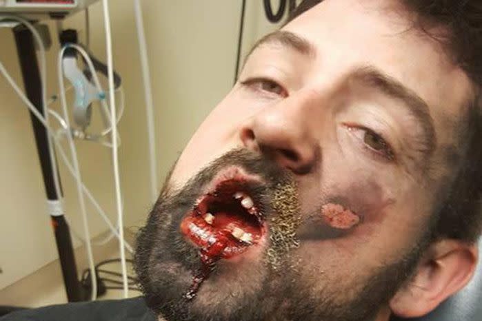 Andrew Hall said he lost seven teeth and suffered second degree burns when an e-cigarette exploded in his mouth. Source: Facebook