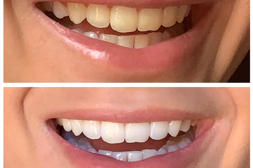 Before and after teeth whitening