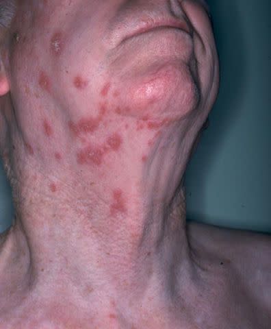 Photo courtesy of the National Institute of Allergy and Infectious Diseases Shingles