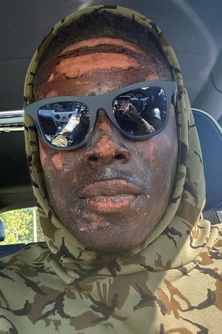 Cleveland Browns tight end David Njoku burned on face, arm in home accident  while lighting fire pit - ABC News