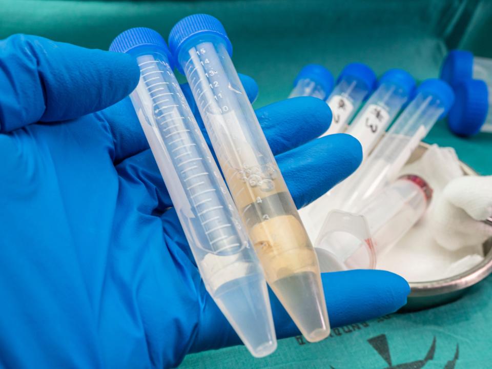 A blue nitrile-gloved hand holds two vials containing cerebrospinal fluid.