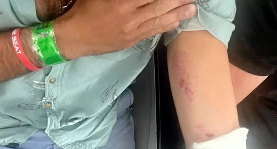 A man's bruising after being injured on a LATAM Airlines flight from Sydney to Auckland. 