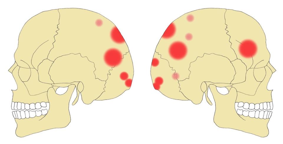 A digital illustration showing a compilation of the skull injuries the Neolithic people sustained just before they died. <cite>Copyright Christian Meyer</cite>