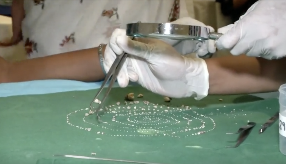 All the teeth which were removed layed out in the operation room. Source: Reuters