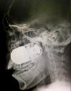 <p>Das Röntgenbild zeigt den kolumbianischen Soldaten Leandro José Luna, dem eine scharfe Granate im Kopf steckt. Ein Kamerad hatte im Juni während einer Patrouille aus Versehen einen Granatwerfer abgefeuert. Wegen Explosionsgefahr wurde das Geschoss auf dem Parkplatz der Klinik herausoperiert. Der Patient überlebte den Eingriff. (Bild: dpa) </p>