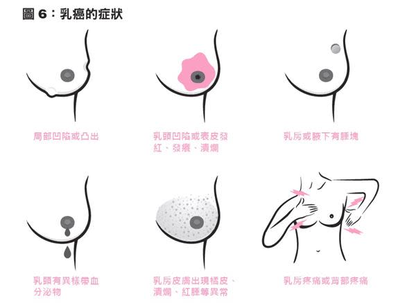 乳房自我檢查做對了嗎？圖解要點大公開