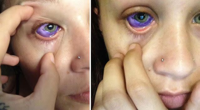 Shocking photos show the purple ink filling the white of her eye and 