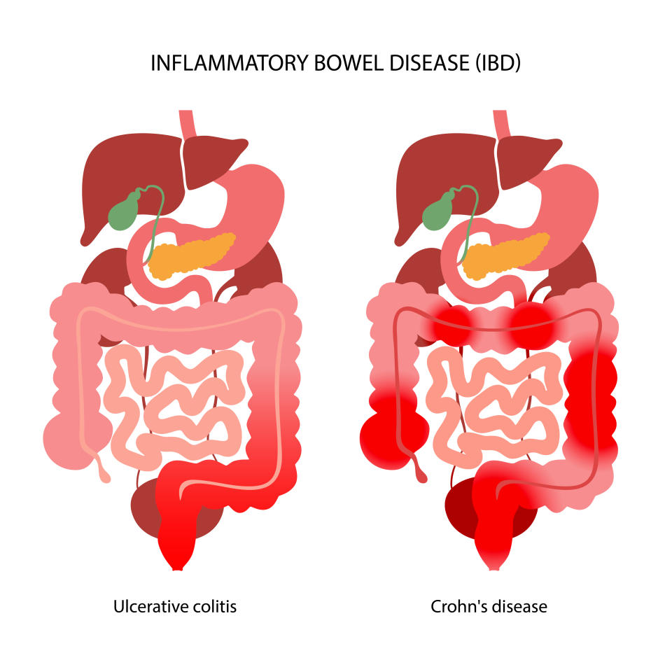 Crohn's disease and ulcerative colitis are two types of IBD that affect different parts of the bowel. (Getty Images)