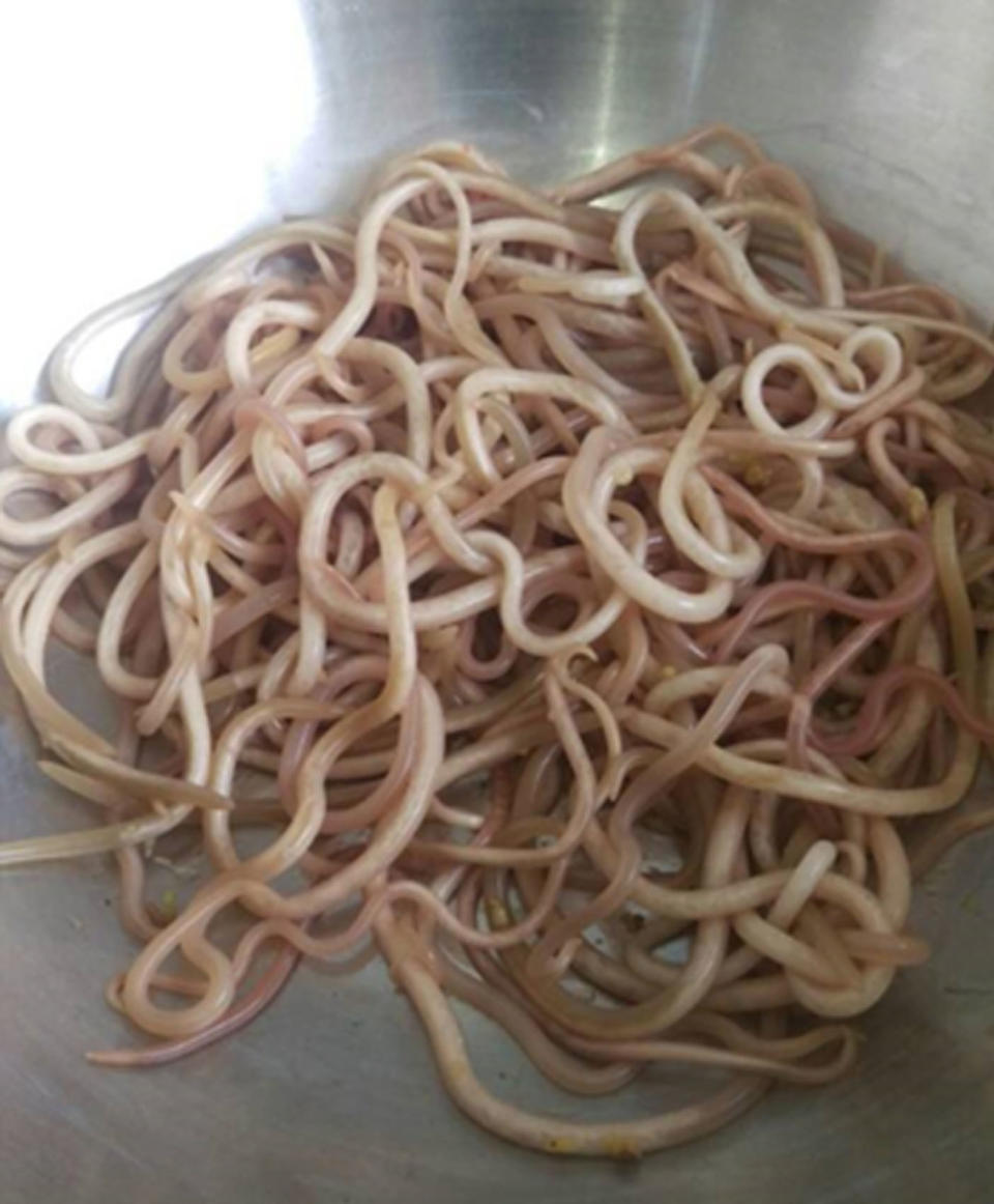 The worms from the boy's intestines at the hospital in Cameroon. 