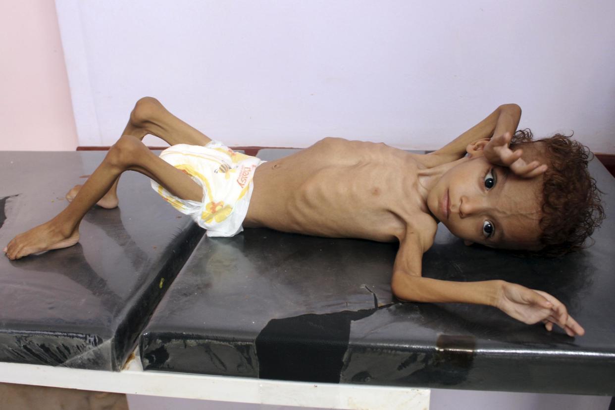 A Yemeni child suffering from malnutrition awaits treatment at a hospital in the northern district of Abs, in Yemen's Hajjah province on August 18, 2018. (Photo by ESSA AHMED / AFP) (Photo credit should read ESSA AHMED/AFP/Getty Images): AFP/Getty Images