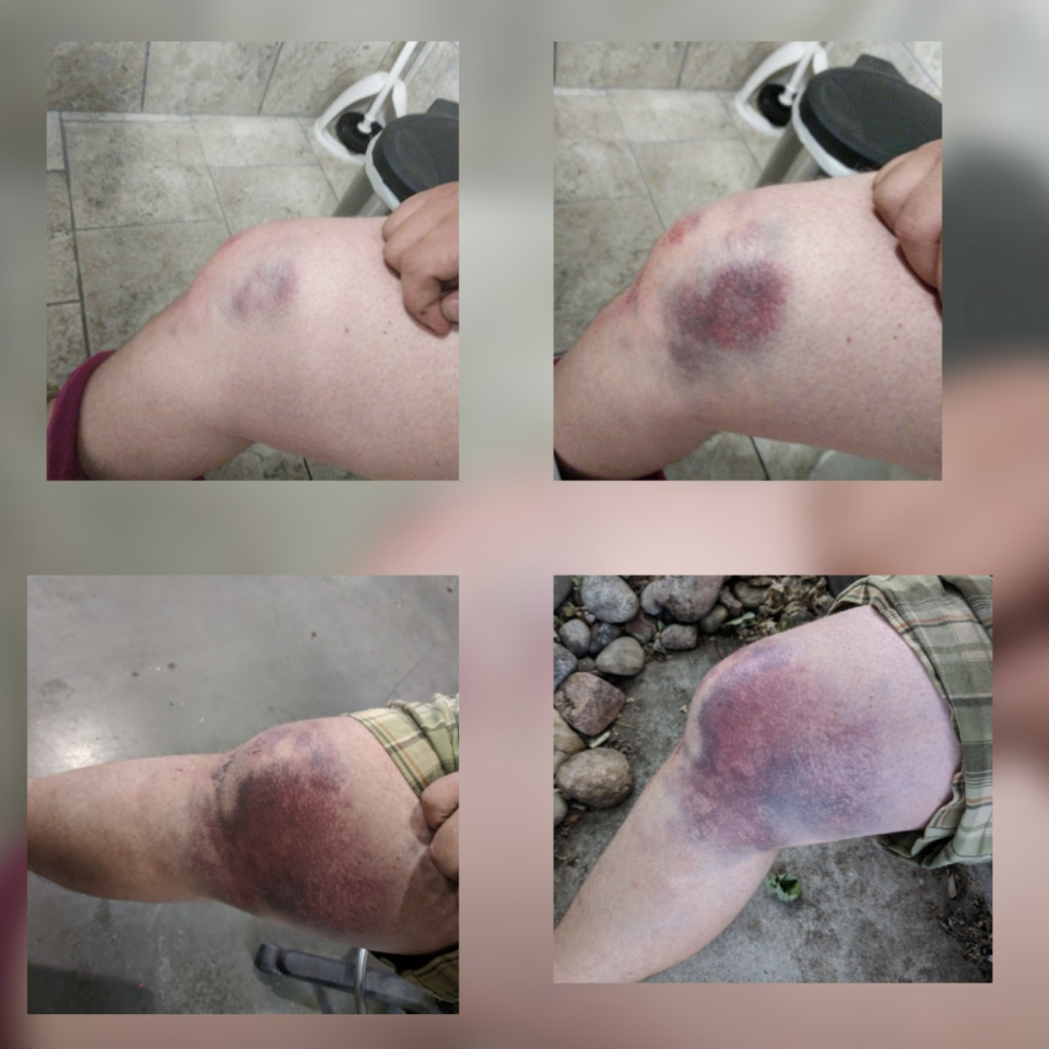 Four-angle view of a person's bruised knee following an injury