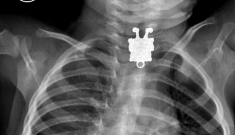 X-ray image showing a small toy lodged in a child's throat