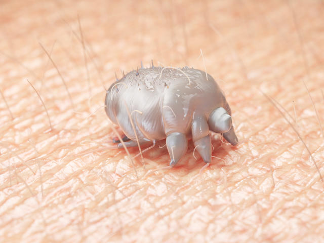 How to reduce chance of getting scabies amid 'nightmare' outbreak