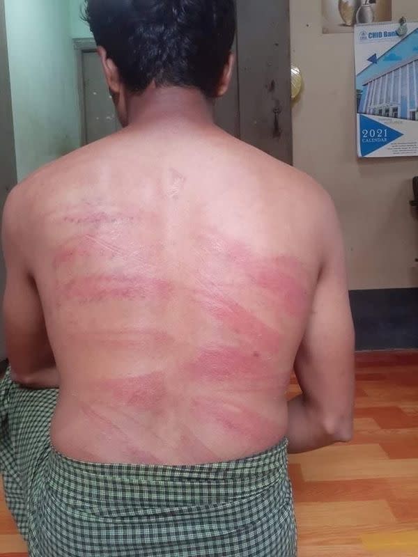 A man, who says he was beaten by soldiers in custody, shows his bruises in Myeik