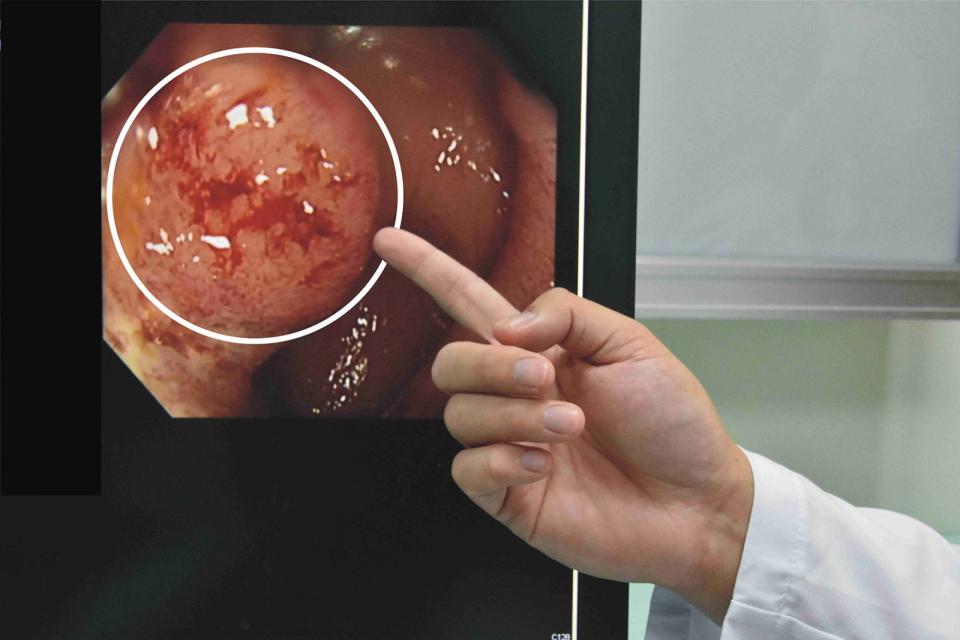 ▲黃阿嬤2021年因排便出血與解便困難而就醫，經大腸鏡檢查後發現4.5公分腫瘤。（彰基醫院提供）