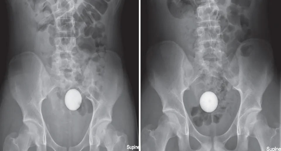 X-ray showing golf ball in large intestine