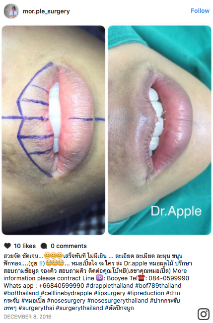 Lip reduction surgery, which involves cutting the lips to reduce their size, is attracting attention on social media.