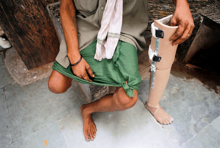 Someone with one leg sits and holds their prosthetic leg