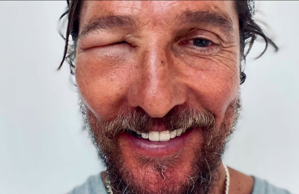 Matthew McConaughey - Bee Sting - Instagram - Collected July 11th 2024