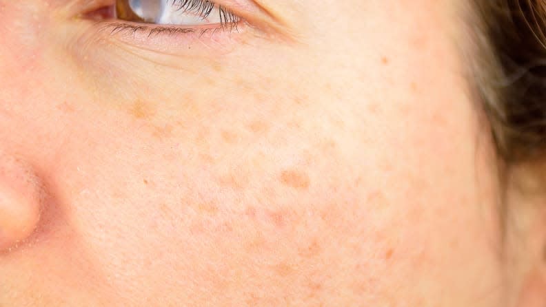 One presentation of cosmetic sun damage is freckles or tan spots on the skin.